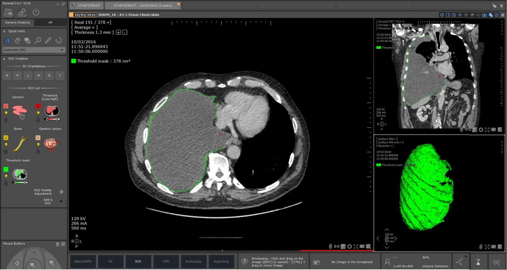 Can Artificial Intelligence Detect Cancer?